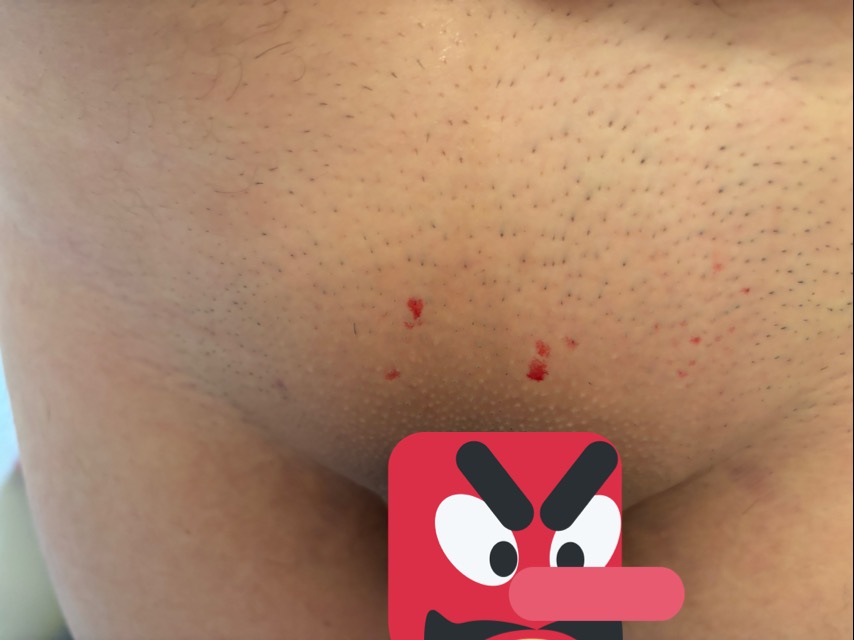 【】アソコの毛